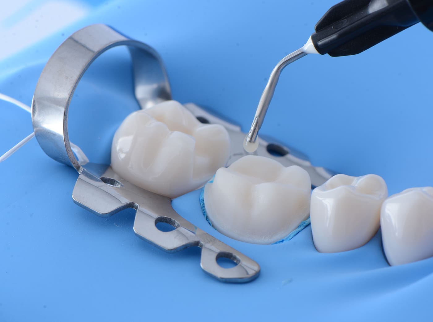 Immediate Dentin Sealing with Rubber Dam High
